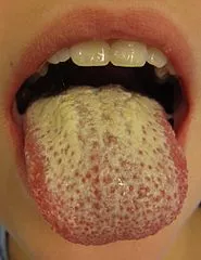 Human-tongue-infected-with-oral-candidiasis