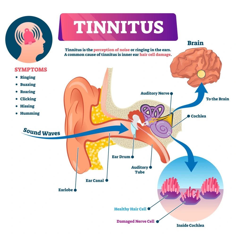 what-is-tinnitus